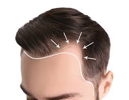 men’s hair regrowth